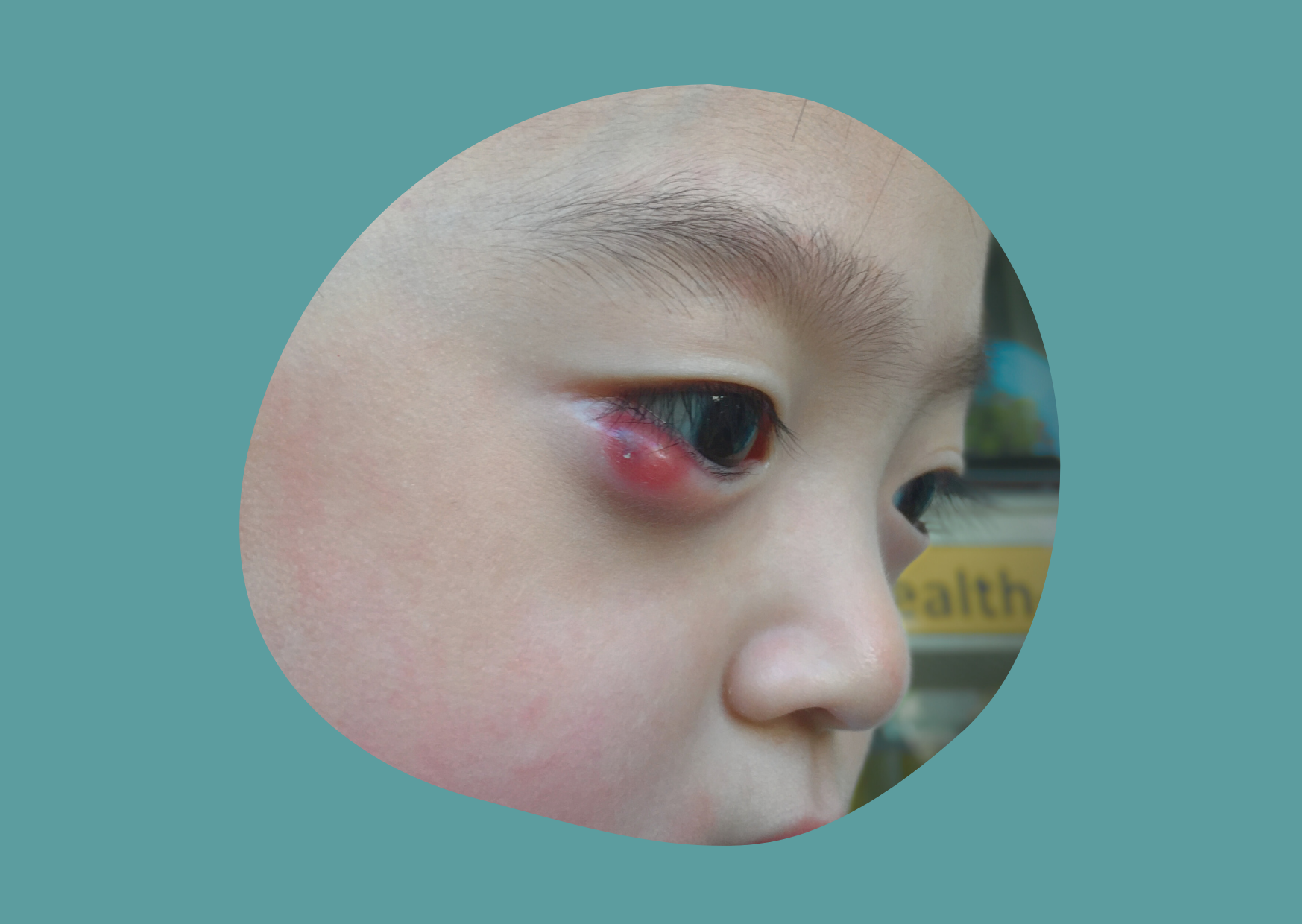 Kids Chalazion 01