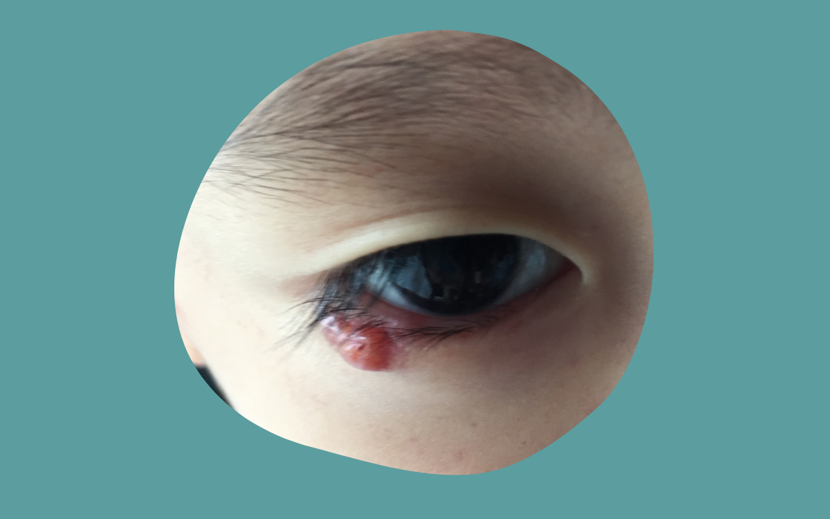 How I got rid of chalazion (and stye) on my child naturally.